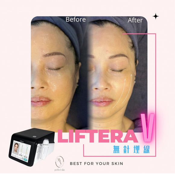 MY Perfect Skin Beauty | Liftera V Extreme Tightening Facial Treatment